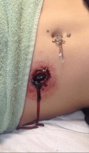 gunshot wound
